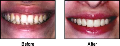 Thin Enamel Teeth